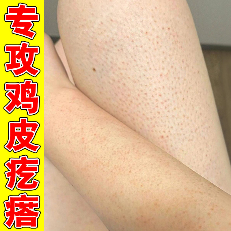 腿上鸡皮毛周角化症修复膏腿部去鸡皮疙瘩毛囊堵塞粗糙颗粒