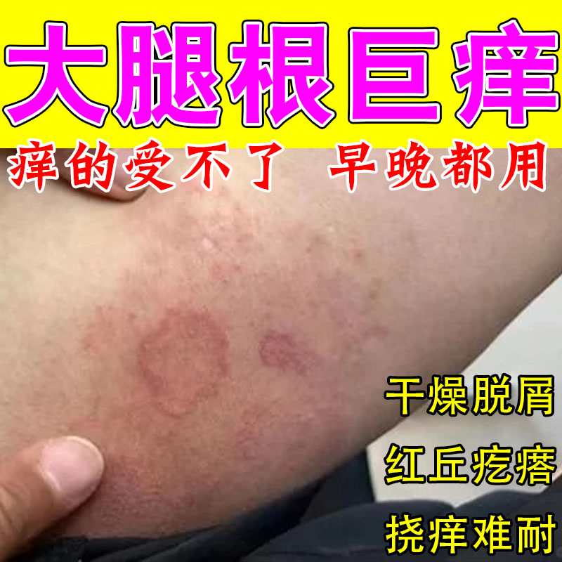 男士大腿内侧痒股皮肤潮腿部大面积痒私处痒干燥起屑修护草本膏