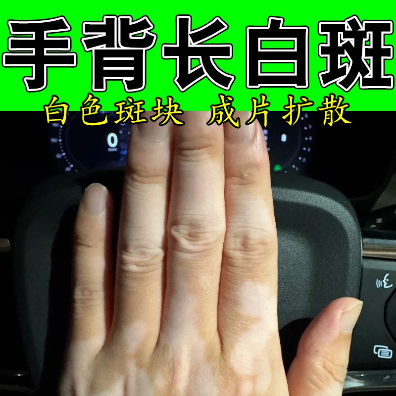 手背长白斑皮肤局部色素脱失外用修复促进黑色素生长手上白色斑块
