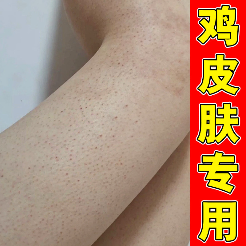 去除胳膊腿上黑点角质毛孔堵塞专用手臂鸡皮疙瘩毛囊毛周角化