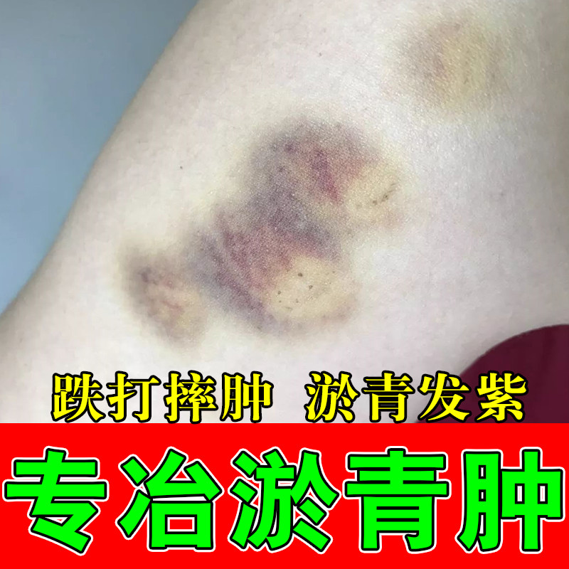 腿上淤青发紫活血化瘀儿童磕碰撞摔伤肿疼痛散瘀成人淤青修护膏