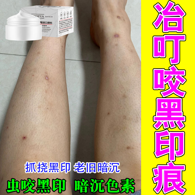 消皮肤黑印蚊虫抓挠暗沉黑斑深色黑印肌肤修护积雪草舒缓按摩膏
