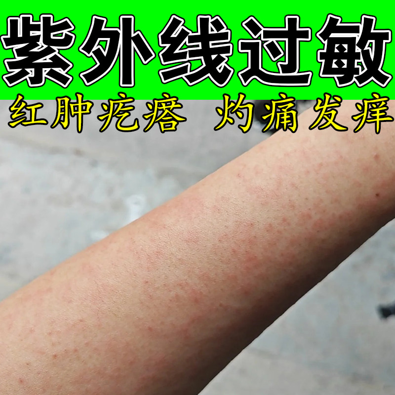 日光性敏感紫外线诱发起疙瘩肿痛泛红太阳灼伤皮肤发痒舒缓修护膏