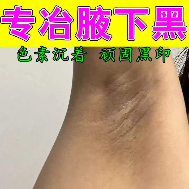 胳肢窝发黑腋窝肌肤暗沉腋下褶皱粗糙腋下角质堆积发黑暗沉修护膏