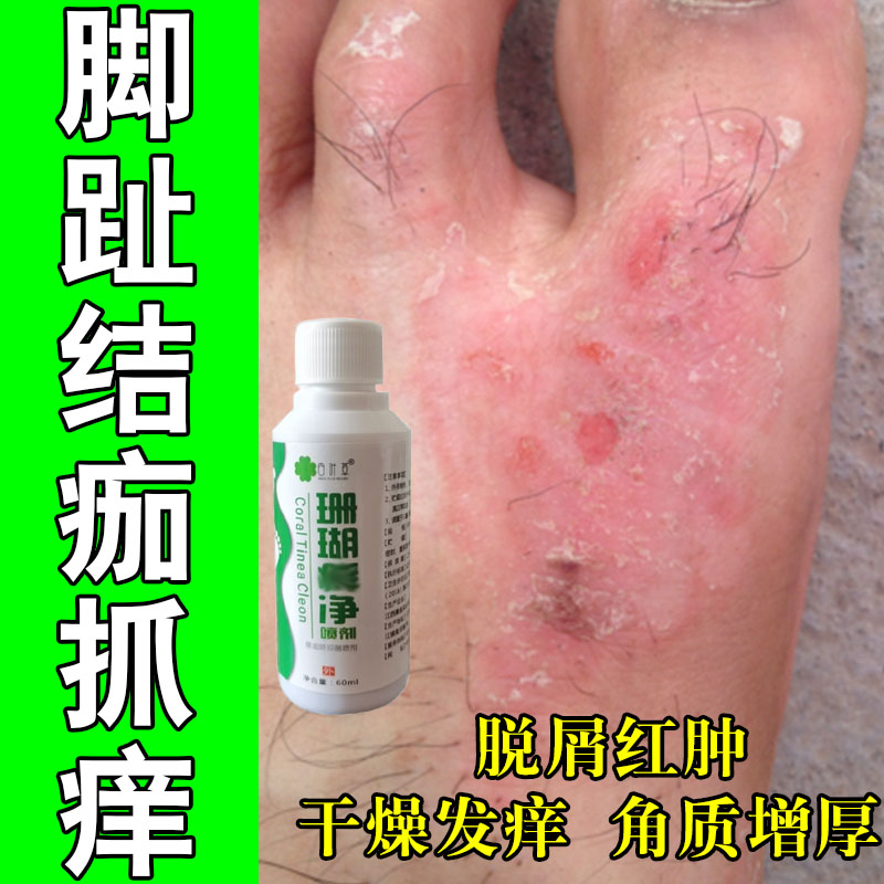 脚面发痒红肿结痂干燥起屑脚背起皮干燥有红疙瘩草本修护保湿软膏