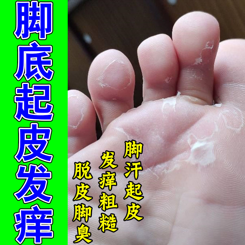 脚掌粗糙起皮脚心厚皮脱屑足部干燥掉皮修护脚部保湿草本软膏