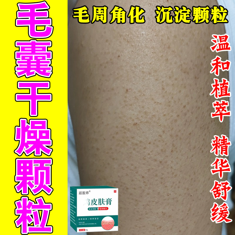 毛周角化鸡皮疙瘩儿童颗粒身上胳膊大腿粗糙凸起草本萃取霜