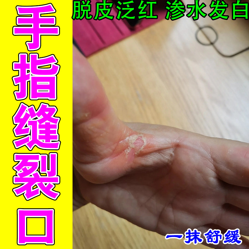 手指缝脱皮痒膏乳手经常碰水起皮手丫开裂脱皮泛红痒水泡专用软膏