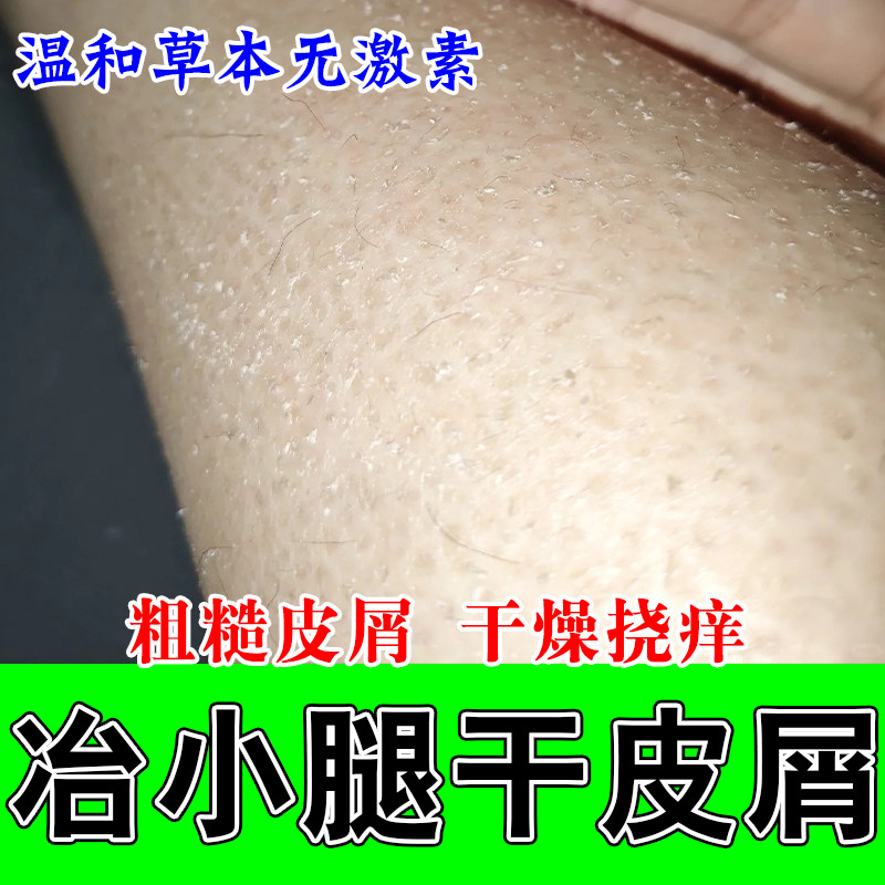 身上腿部干燥粗糙起皮皮肤痒遇热身上缺少干燥保湿修护甘油