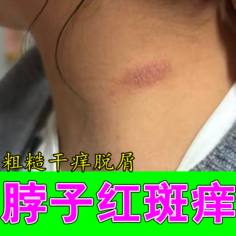 冶脖子皮肤过敏痒刺挠膏脖子出汗发痒红疙瘩粗糙干燥修复乳膏