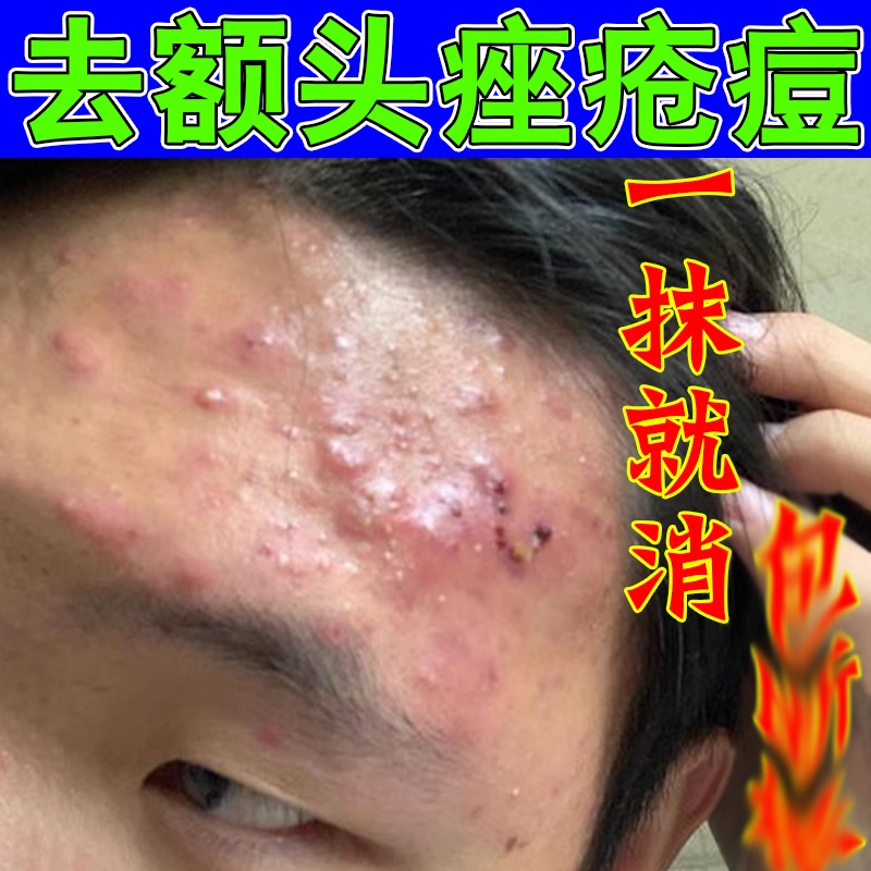 痤疮膏祛痘重度暗疮去淋巴痘腮边痘玫瑰痤疮闭口粉刺脸部特效药膏