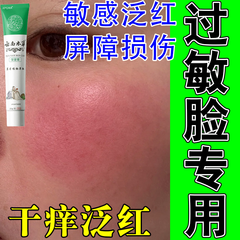 脸泛红发痒灼热干皮面部刺痛敏感不适天然植萃舒缓修护膏