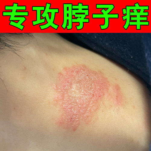 脖子后面发痒长红斑刺挠颈部上起红疙瘩红点外用修复膏