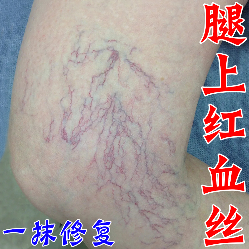 静脉曲张特效专用的药膏贴腿上有红血丝腿部青筋凸起老烂腿蚯蚓腿