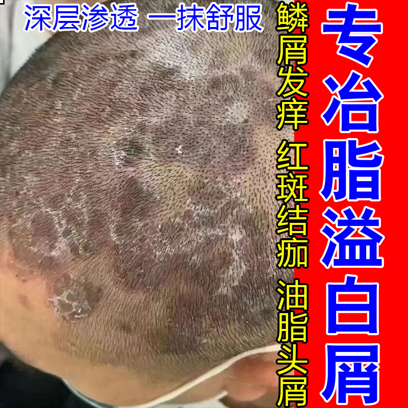头皮白屑白斑结痂发痒起皮脱屑粗糙发痒红肿干燥起皮草本配方膏