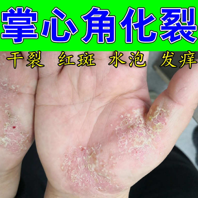 冶掌趾干裂手掌手掌手干燥起皮角质增厚泛红干裂粗糙保湿外用软膏
