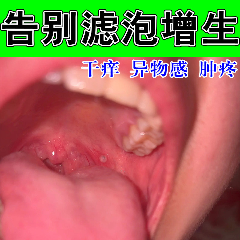 咽喉淋巴滤泡增生喉咙发红发热异物感水泡红肿咽喉修护喷剂