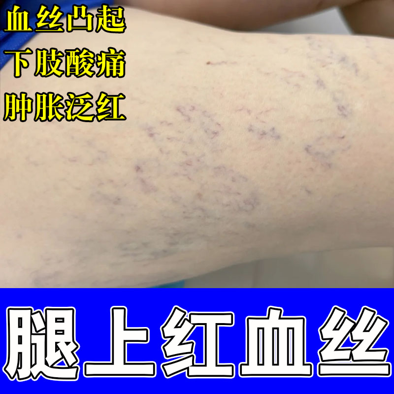 腿上红血丝干燥粗糙腿上紫红血丝明显青筋凸起红血丝严重草本膏