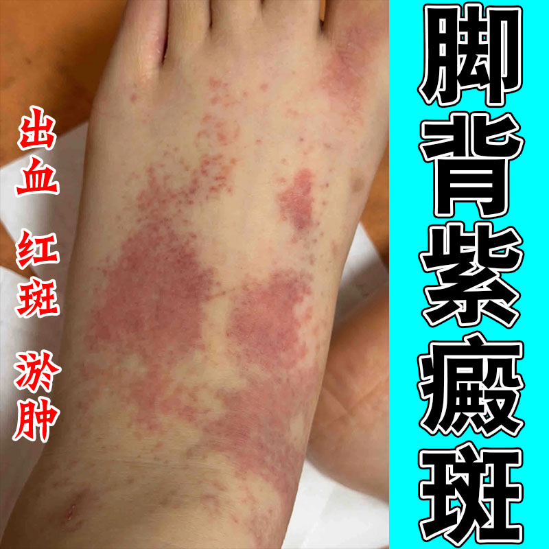 冶过敏性紫癜四肢红点淤点肌肤色素沉淀草本修护膏