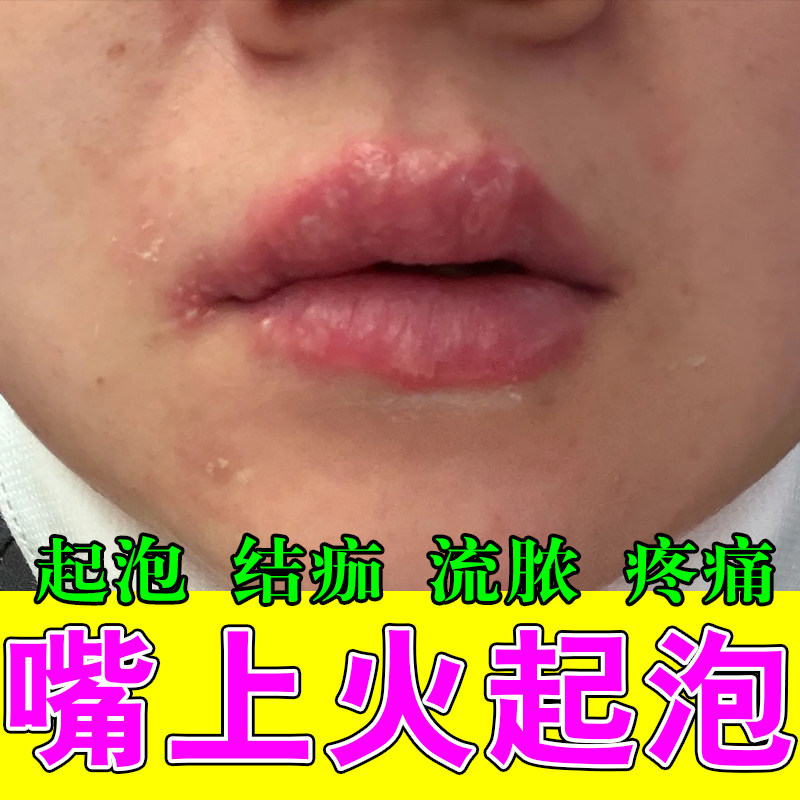 嘴巴水泡修护唇部保健修复膏唇部脱皮脱屑干裂口角开裂唇上火疼膏