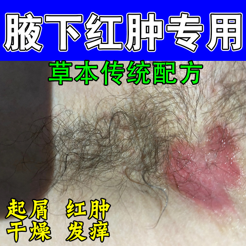 腋窝红肿疼痛痒防摩擦干燥粗糙起屑痒干燥起屑痒红草本修护温和膏