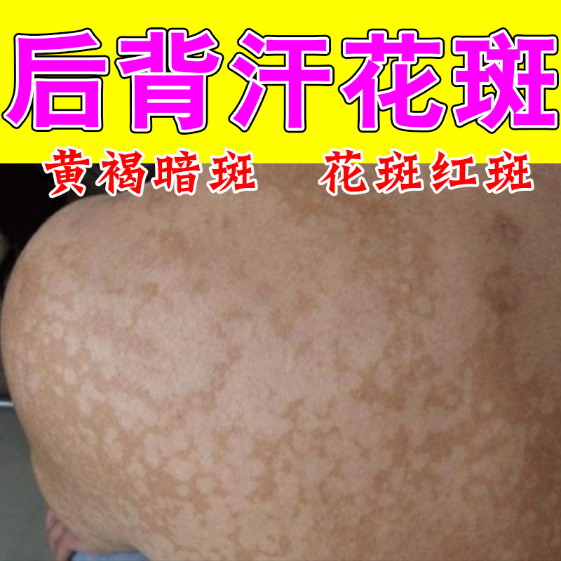 汗斑净花斑专效深色白斑后背用去腋下花斑汉斑草本修护膏乳膏
