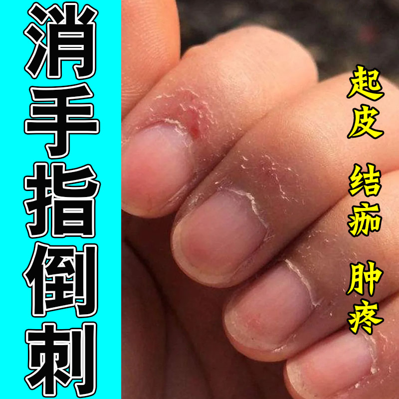 儿童手指倒刺专用草本保湿修复乳膏指甲边缘起肉刺小孩手上干燥
