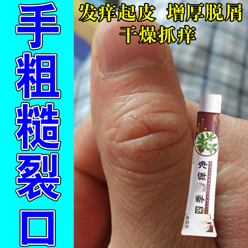 手指关节真菌手指关节长硬疙瘩粗糙脱皮手真菌硬块结痂修护保湿膏