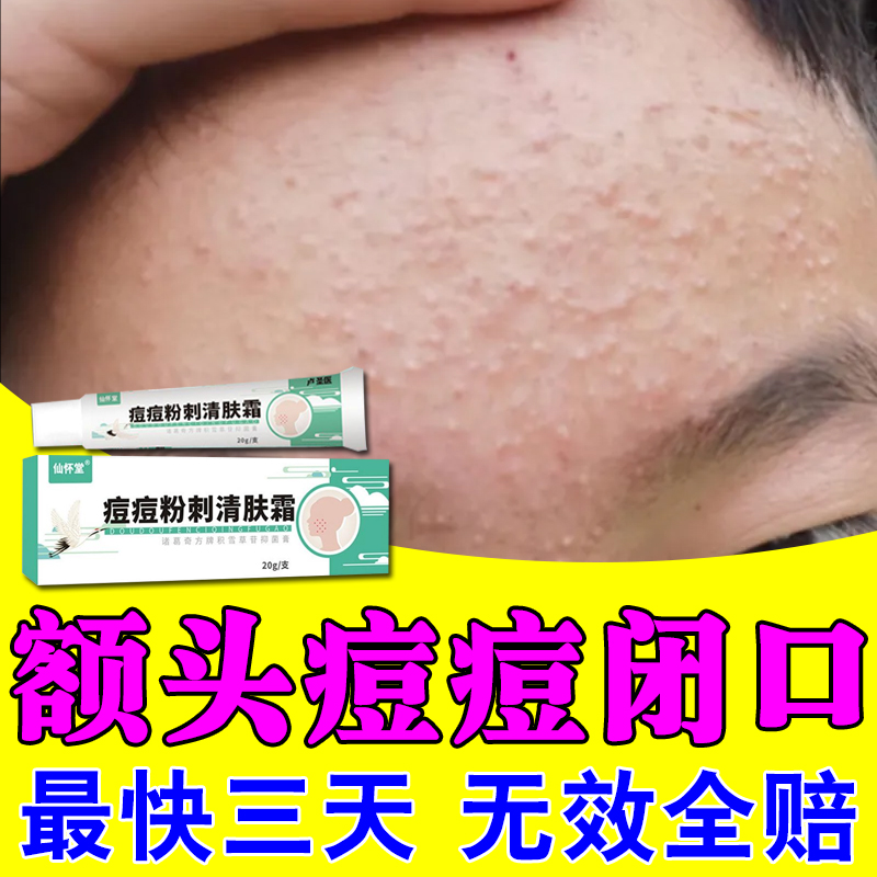 额头上长痘痘闭口粉刺内分泌失调上火脸上长痘痘祛痘印痘坑