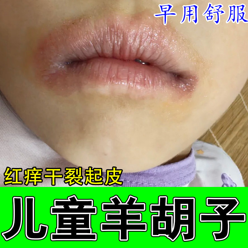 冶羊胡子疼嘴巴周边泛红结痂干疼舔唇起皮干裂不适肿疼干燥修护膏