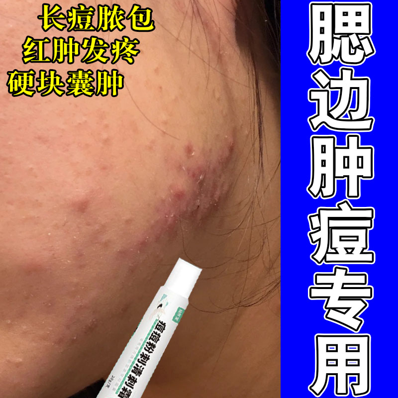 腮边淋巴长痘上火红肿疙瘩修护反复胀痛流脓温和草本保湿乳膏