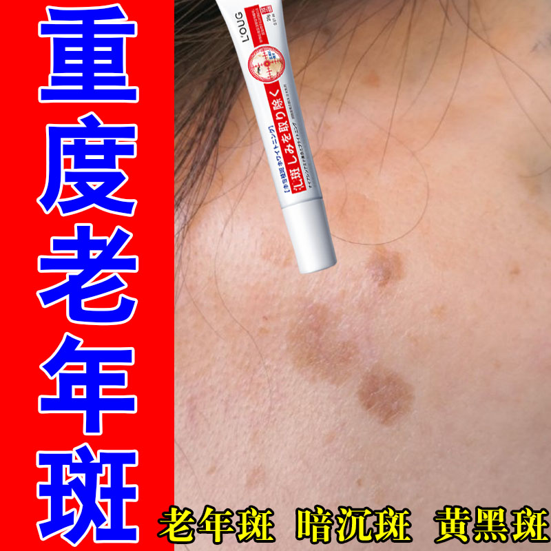 老人脸上黄斑雀斑暗沉脸上黑色素脸部黑点斑脸颊长斑点植物萃取膏