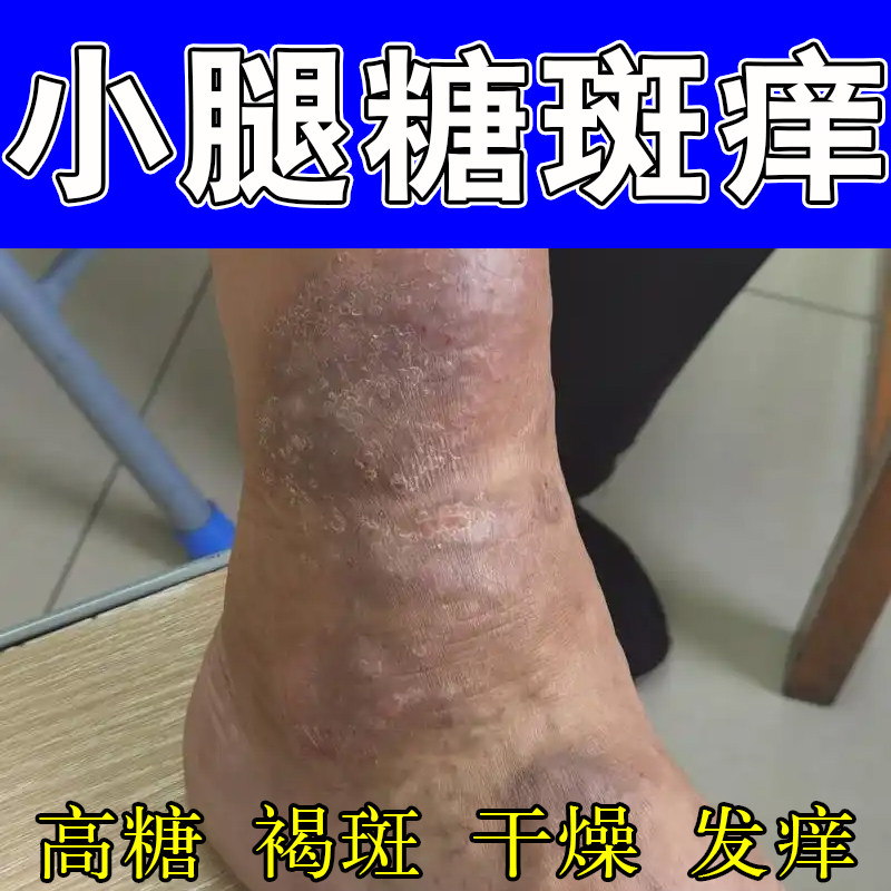 腿上小腿脚上褐色大块糖斑肌肤干痒起皮长疙瘩发痒暗沉植物修护膏
