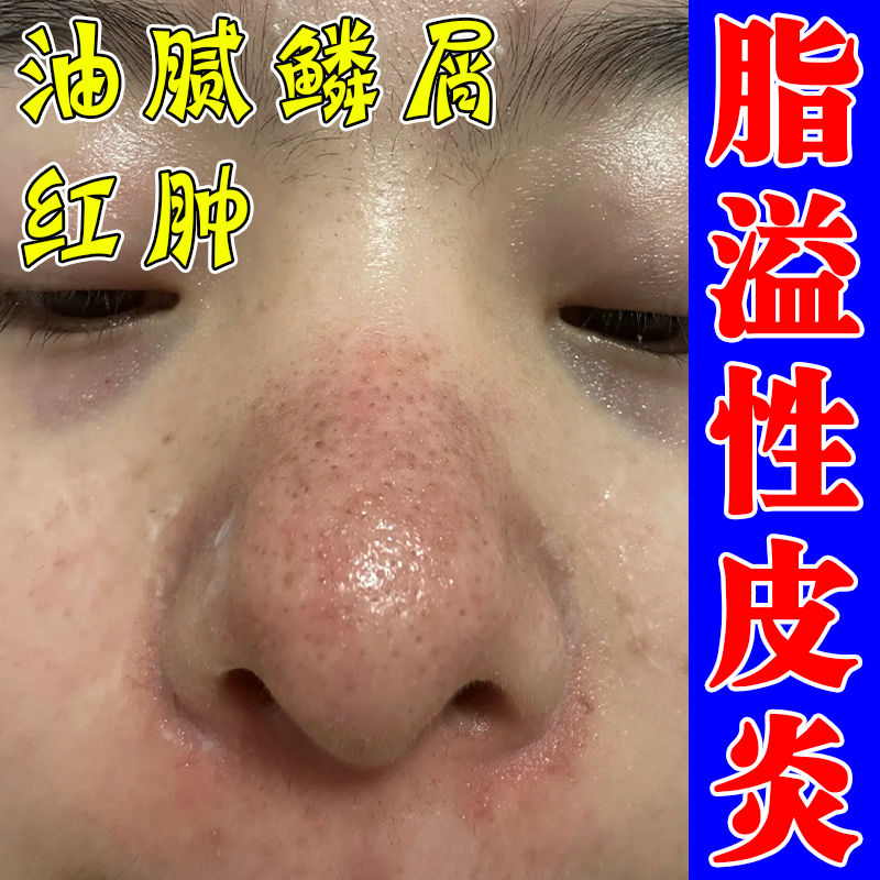 鼻翼脸部脂溢性皮炎鼻翼两侧面部泛红起皮专用修复软膏