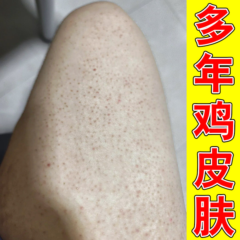 胳膊腿上上长鸡皮疙瘩毛囊毛周角化红黑点小颗粒专用