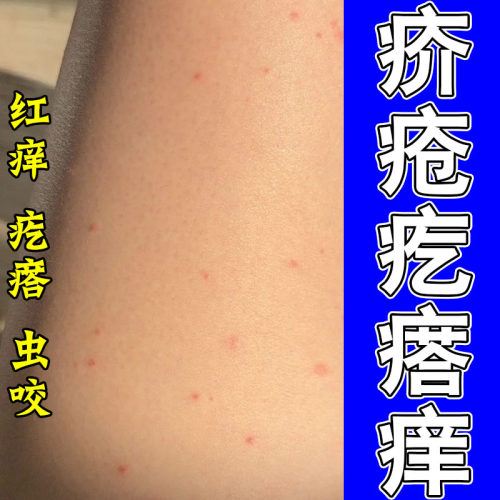 周身连片红疙瘩虫咬全身刺痒抓挠结痂温润修护植物保湿乳