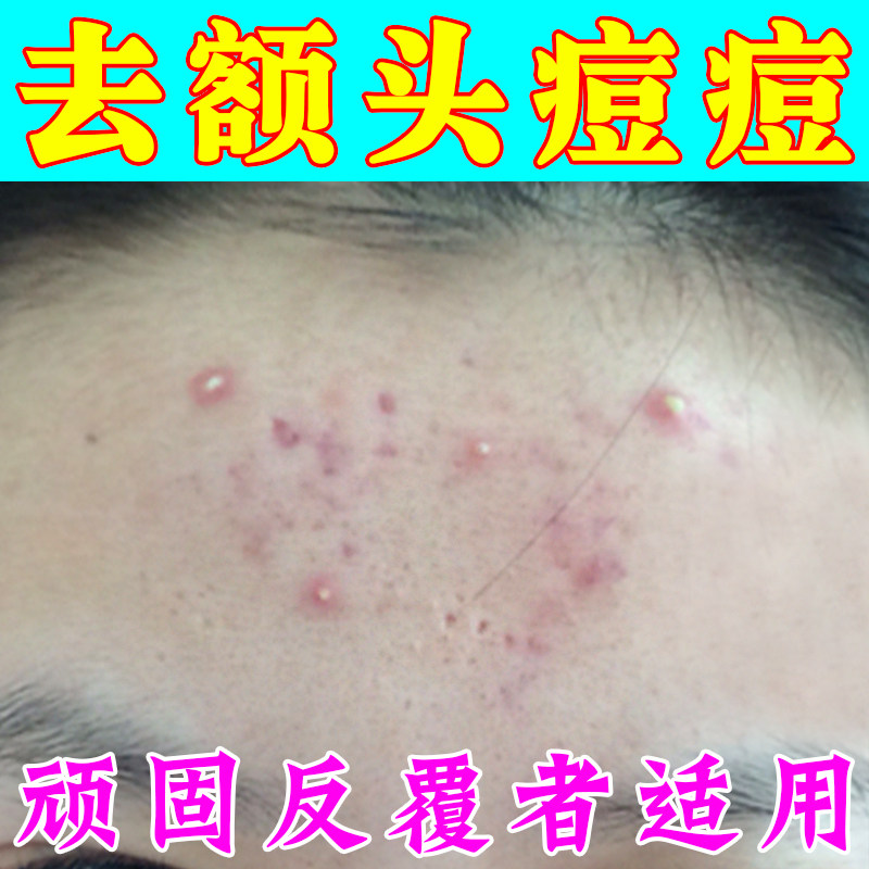 学生额头上长痘闭口粉刺起小颗粒疙瘩淡化去豆豆膏