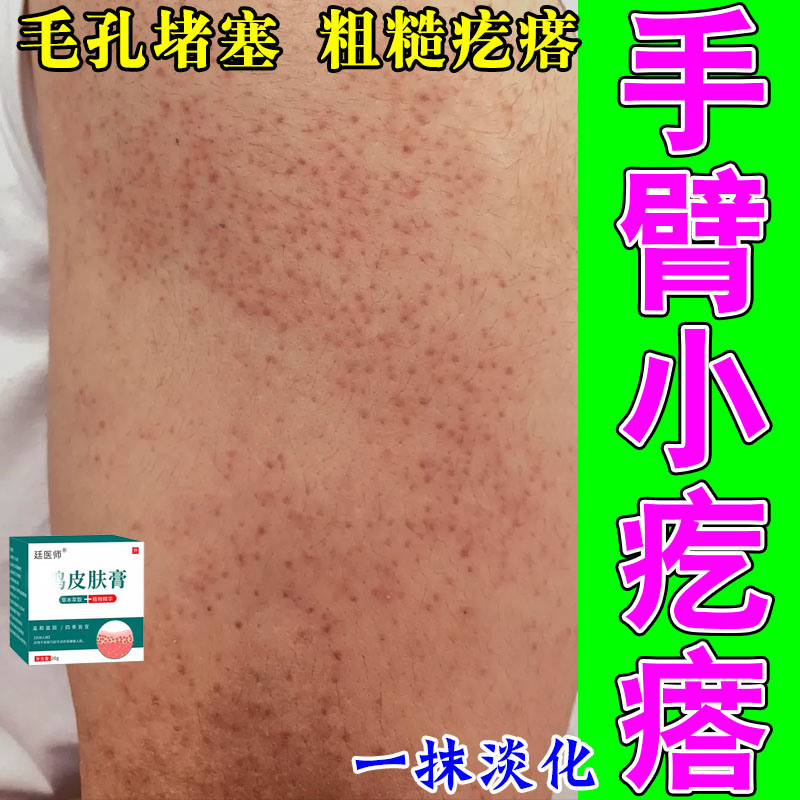 身上大腿手臂鸡皮肤疙毛囊角化毛孔粗大堵塞红点角质修护草本霜