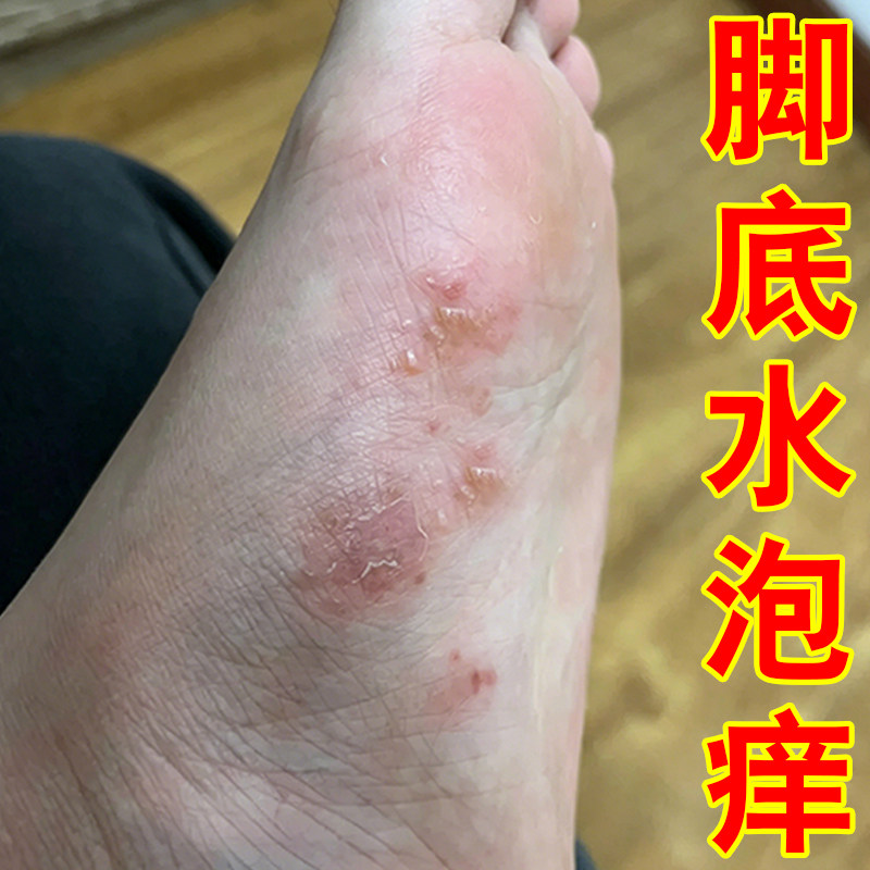 脚上长小水泡痒脱皮透明小水泡专用软膏
