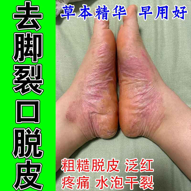 掌跖部位手脚干燥起皮干裂角质增厚干燥开裂粗糙泛红润肤呵护膏