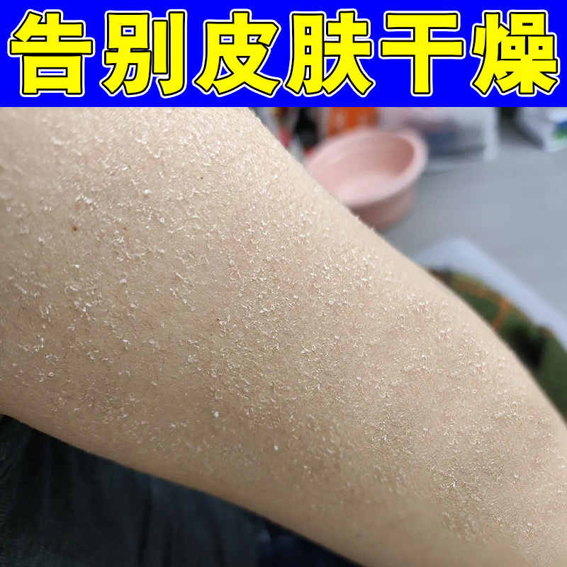 腿上干燥起皮小腿秋冬天起皮掉皮屑腿部蛇皮肤保湿补水