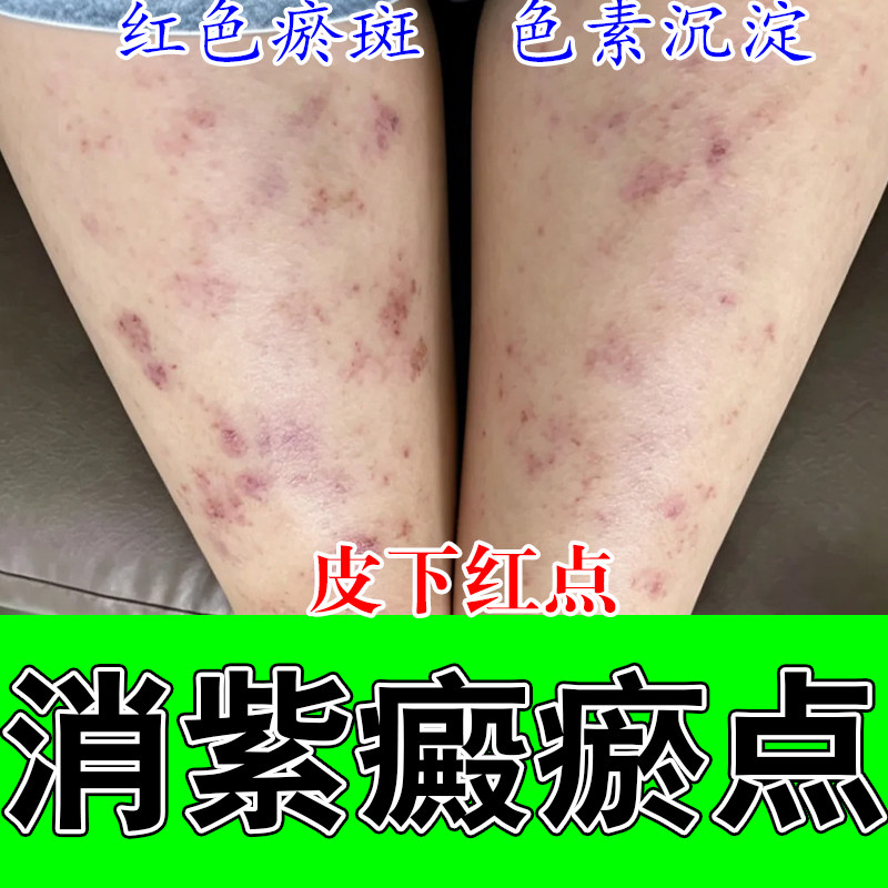 去紫癜出血点皮下红点肌肤瘀斑暗沉色素过敏性癜修护外用膏