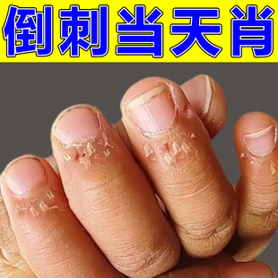 手指倒刺营养油儿童成人指甲边缘脱皮肉刺软化修复神器滋润去死皮