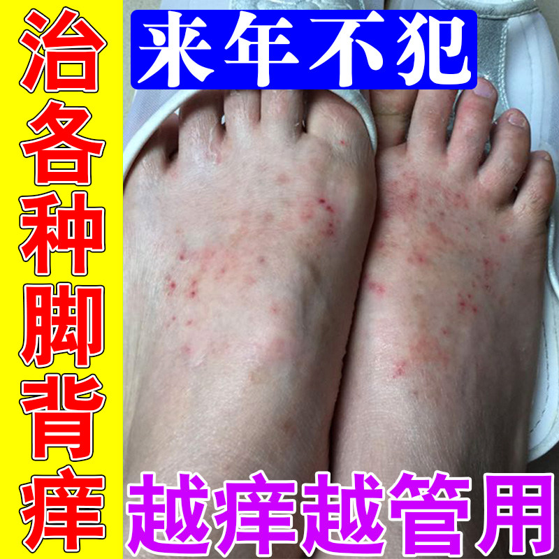 脚背发痒脚上起红疙瘩起红斑软膏
