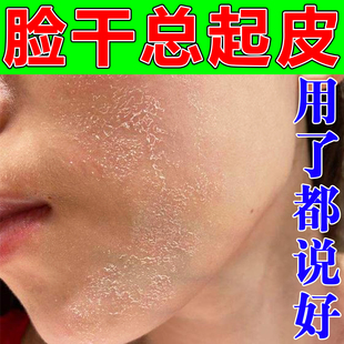 脸起皮干燥有碎屑嘴角下巴修复面霜皮肤泛红痒补水保湿冬天男女士