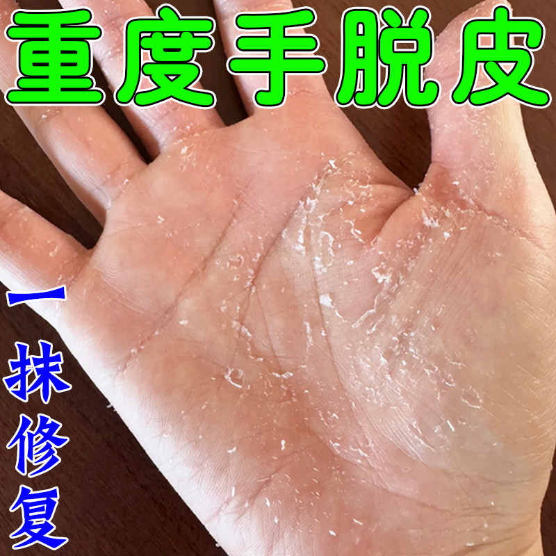 手脱皮严重脱皮专用剥脱性角质冶手脚起皮干燥爆皮