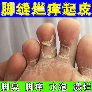 脚脱皮脚底板脚指缝干燥开裂掉皮蜕皮脚发痒脚臭汗脚