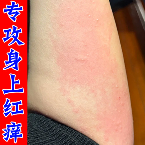 身上皮肤发痒长小红点胳膊起红疙瘩换季性外用膏