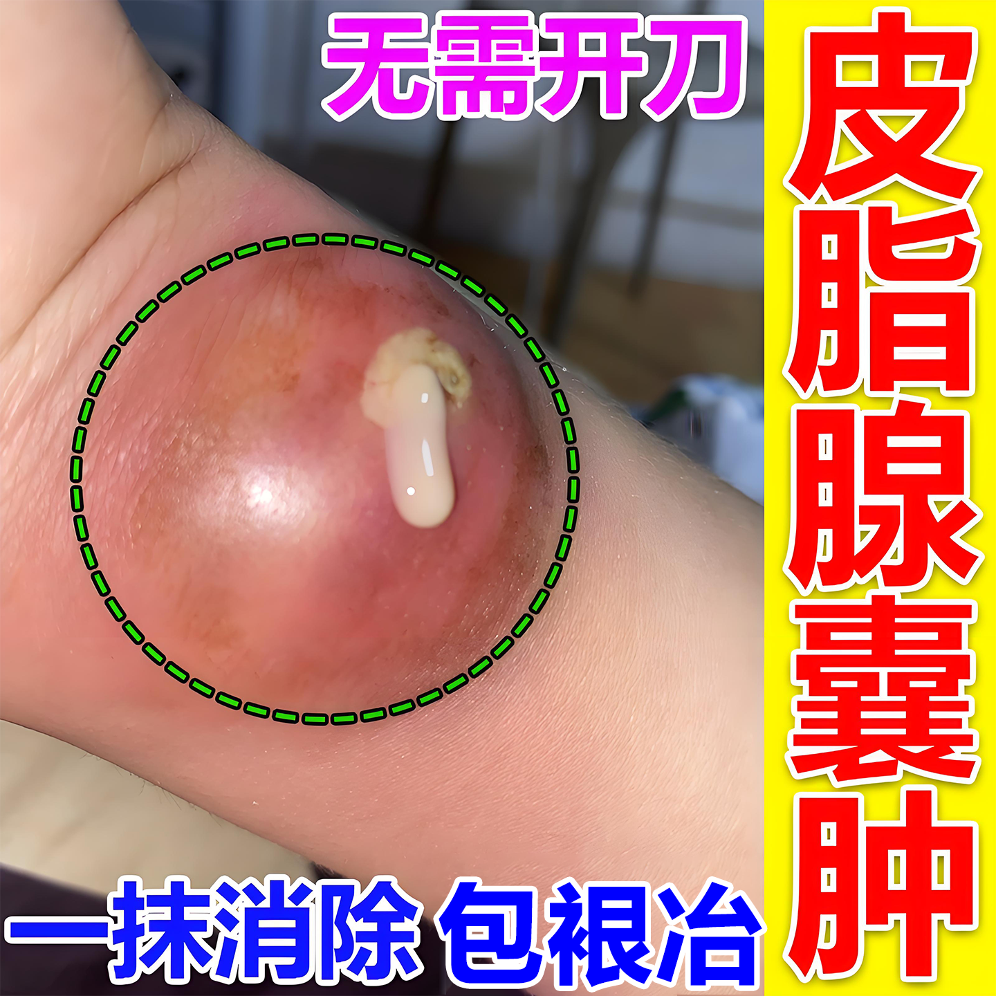 皮脂腺囊肿膏药贴刀火疖子皮下硬块粉瘤鼓包去除痘痘囊肿拔脓痤疮