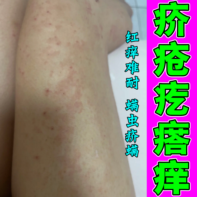 疥疮膏硫磺药身上长红疙瘩痒螨虫脓包皮肤痒专用修复膏疙瘩痒外用